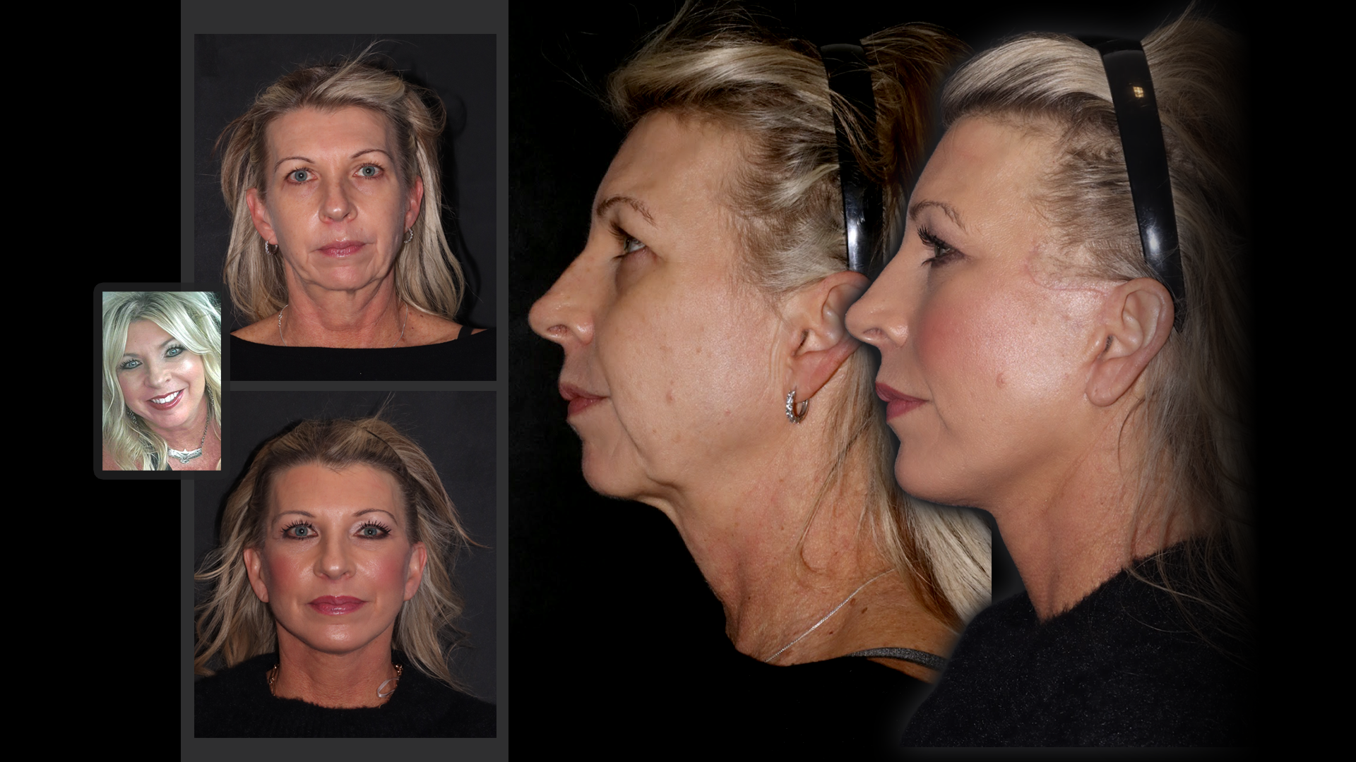 Case 0301 — deep plane facelift, twelve months post-op