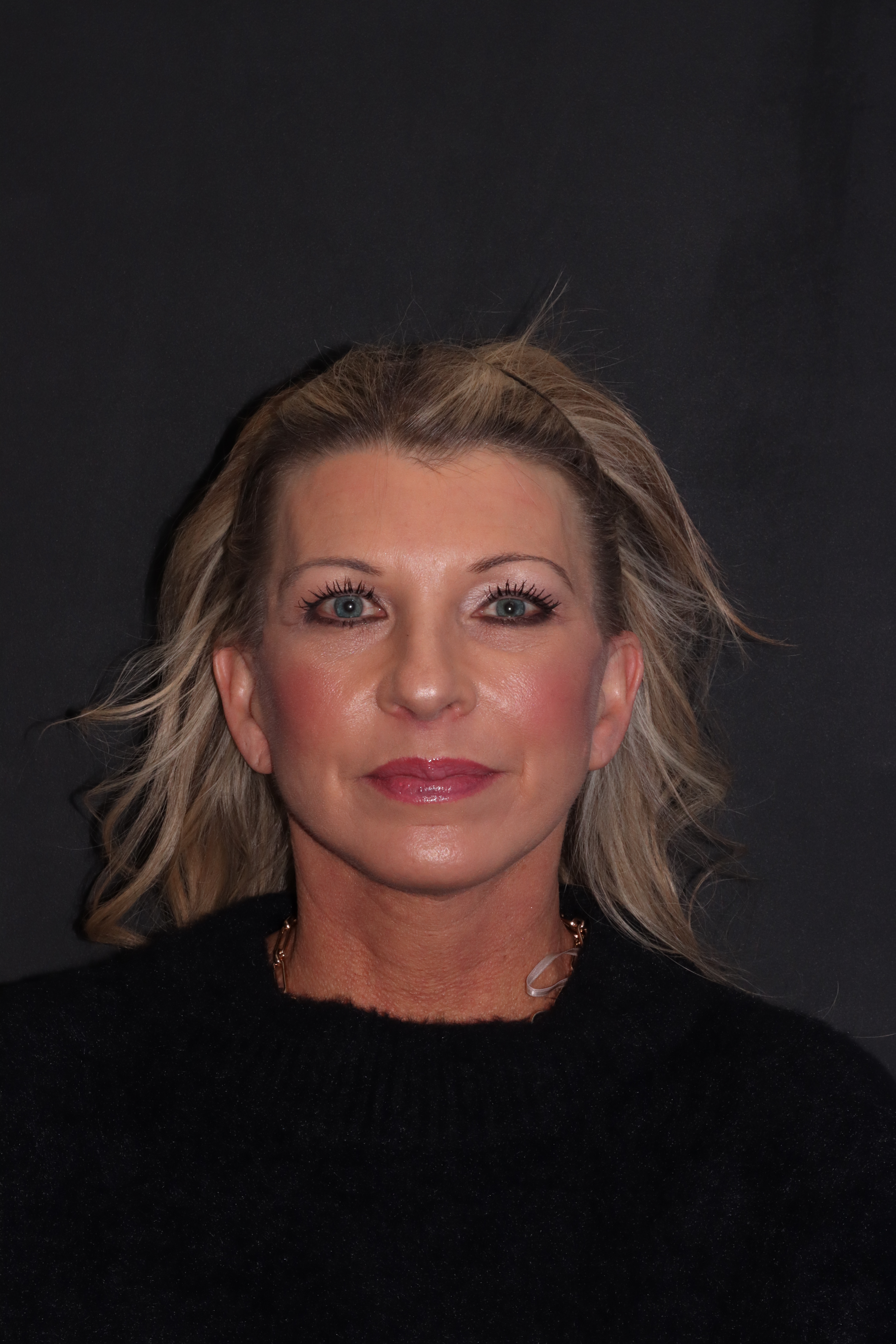 After — front