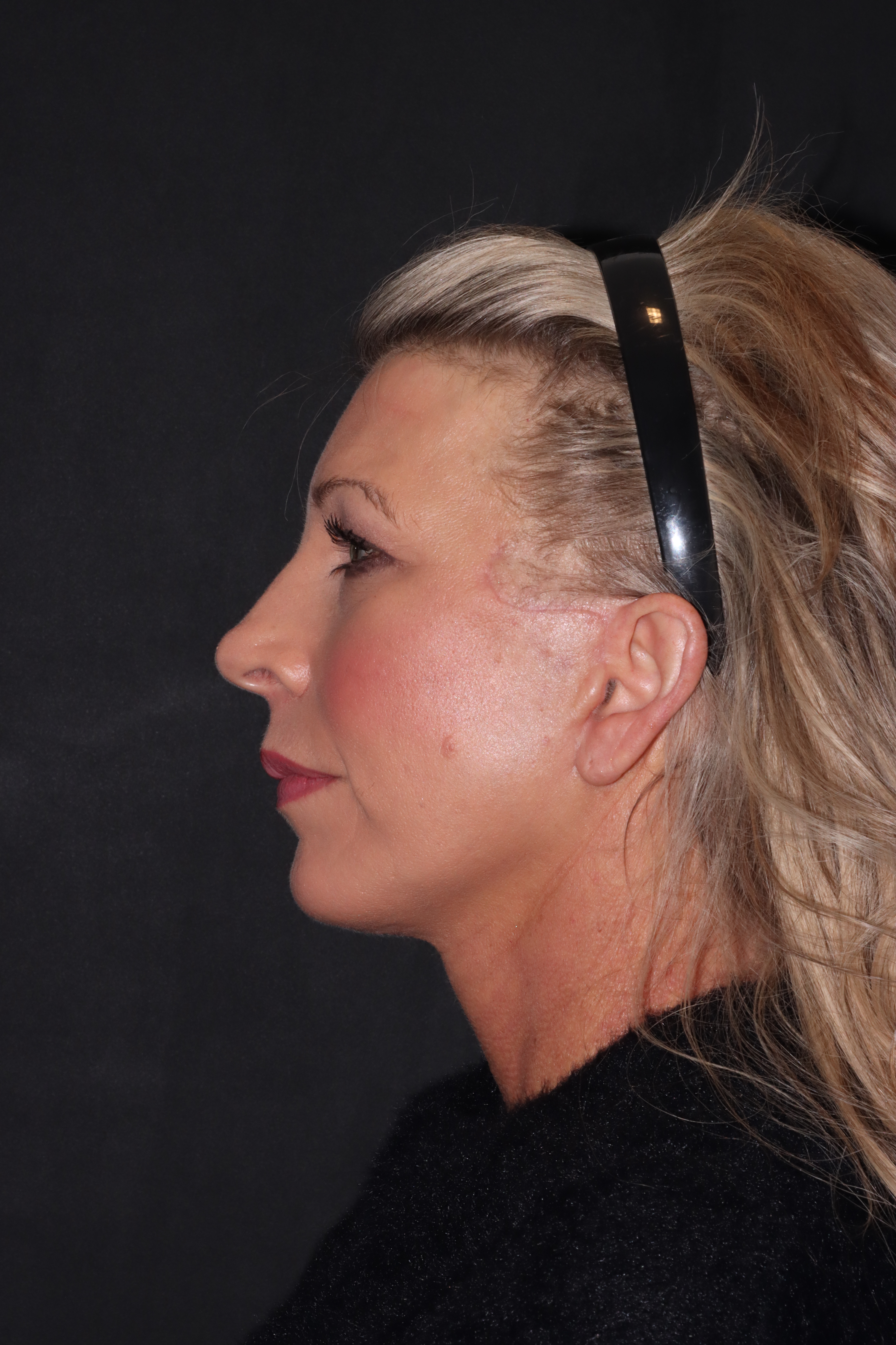 After — profile
