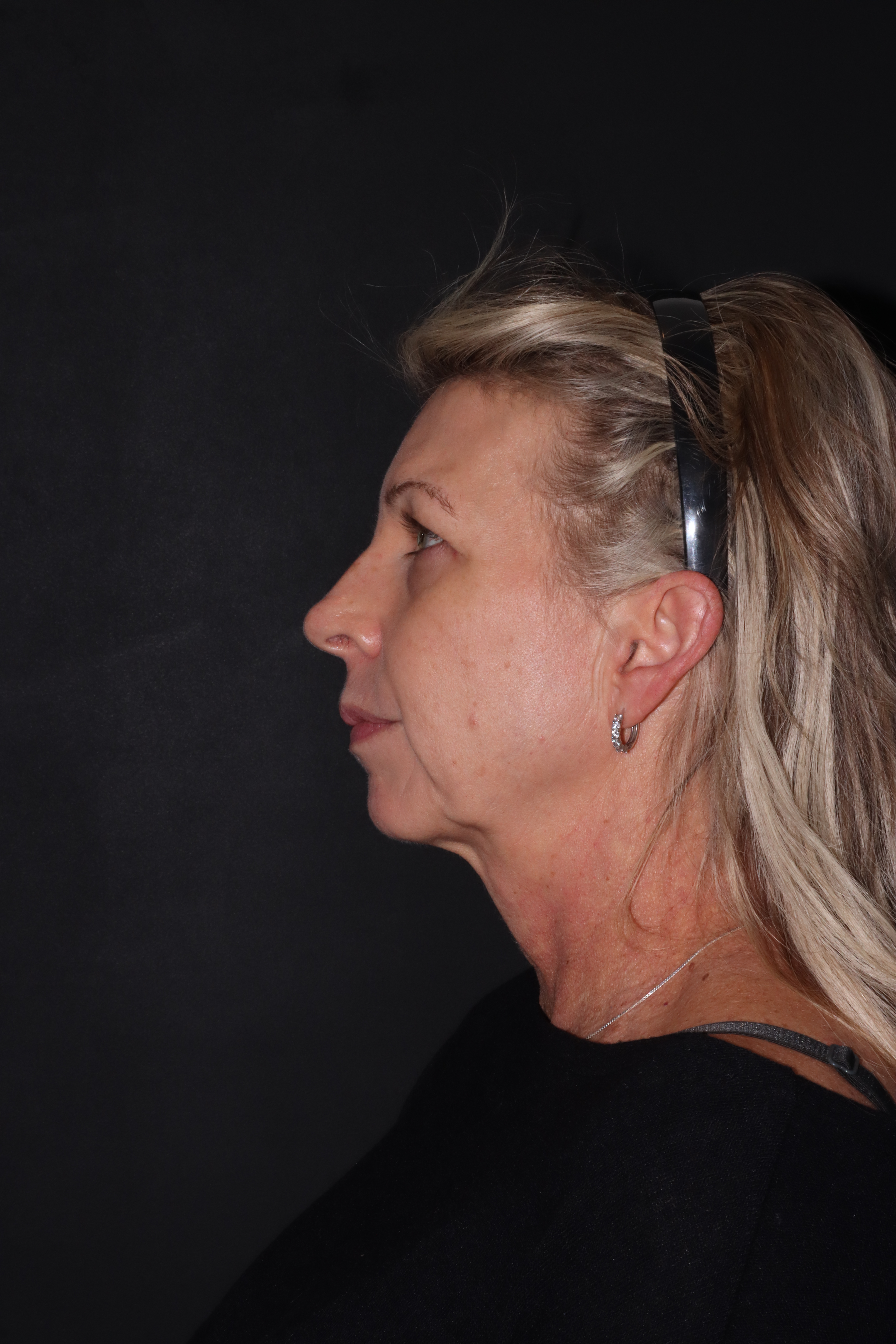 Before — profile